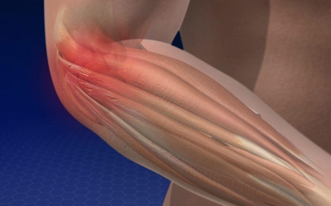 Έξω Επικονδυλίτιδα (Tennis Elbow)
